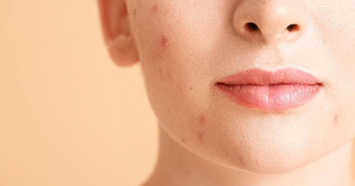 Close up on woman's face with acne